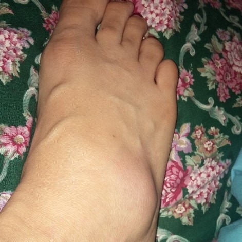 Life Update - Swollen Foot