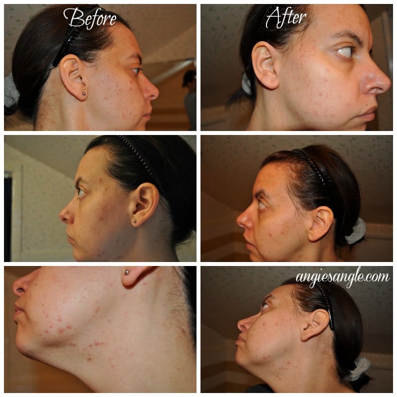 Nu Skin Clear Action Acne Medication System - Before and After All Over
