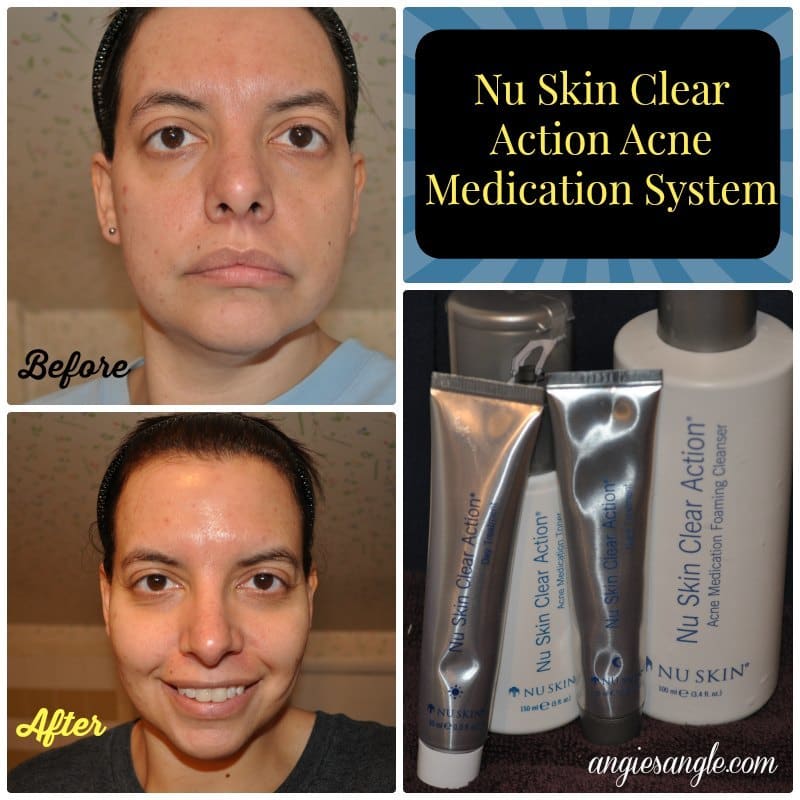 Nu Skin Clear Action Acne Medication System - Before and After