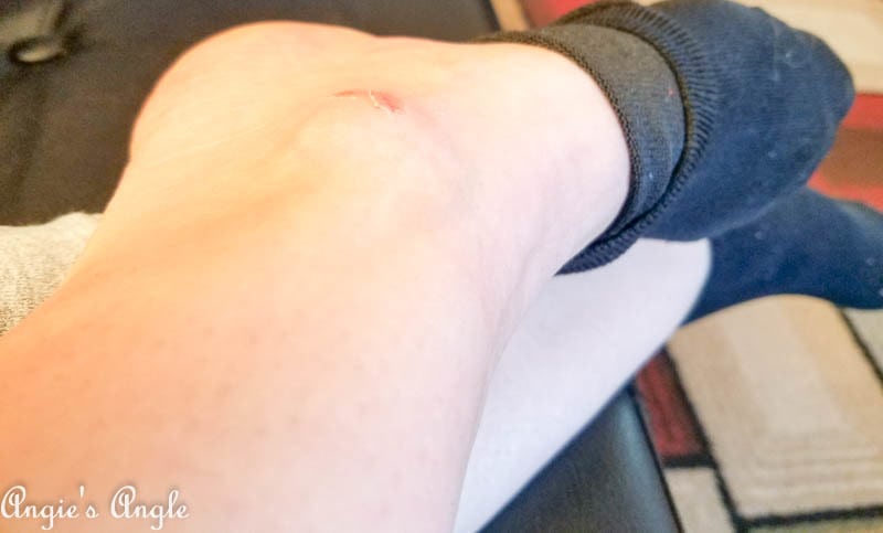 2017 Catch the Moment 365 Week 14 - Day 92 - Owie Ankle